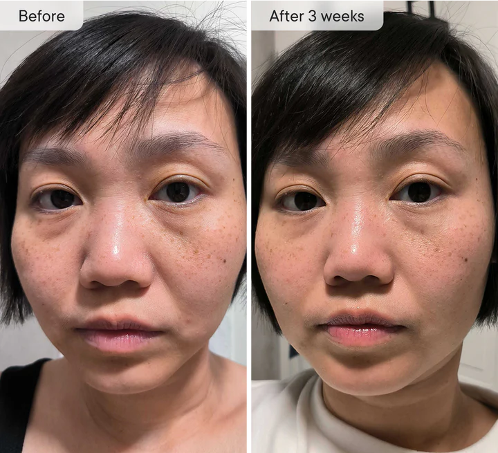 Micro-Infusion Targeted Patches